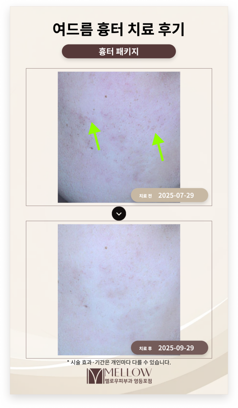 20대 여드름 흉터 치료 후기 #여드름 흉터 치료방법 소개