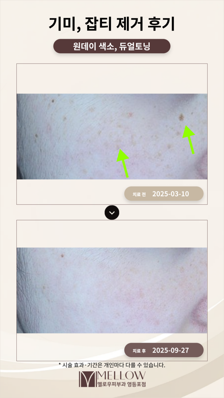 40대 기미, 잡티 제거 후기 #부작용 적은 레이저 치료 방법