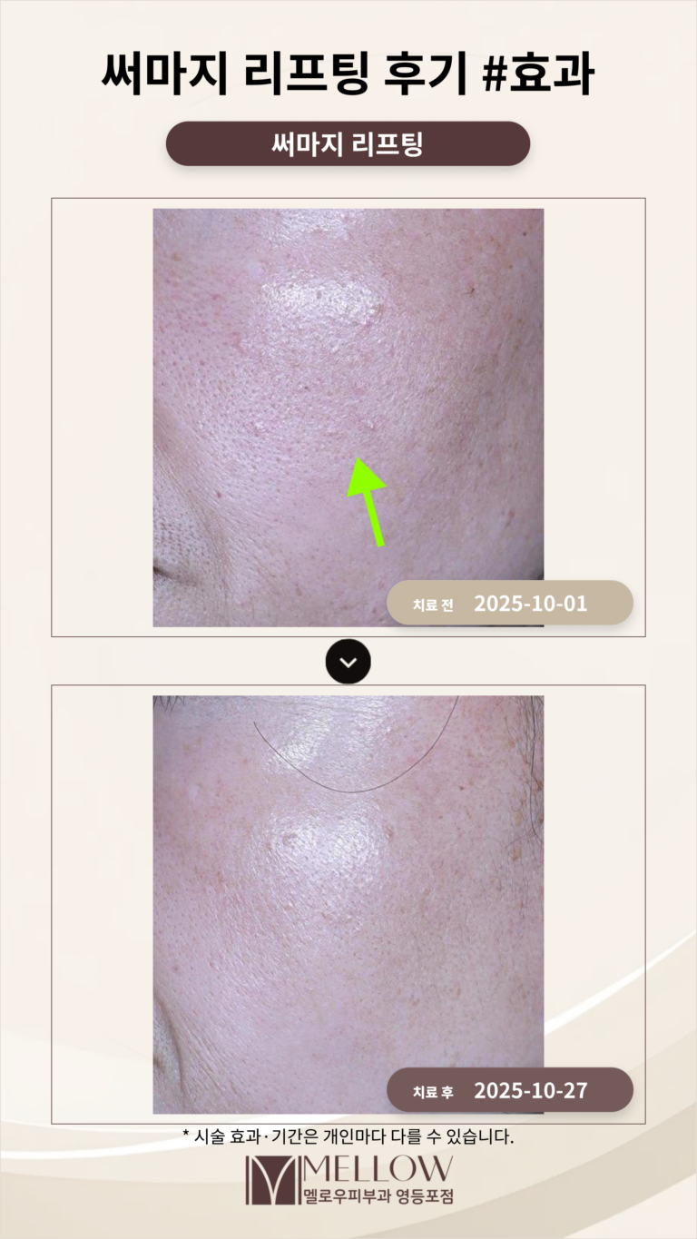 50대 써마지 리프팅 후기 #효과