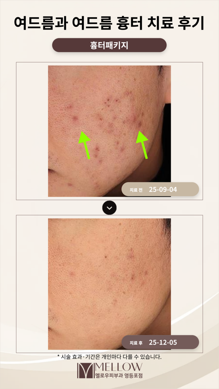 여드름과 여드름 흉터 치료 후기_영등포 피부과 전문의