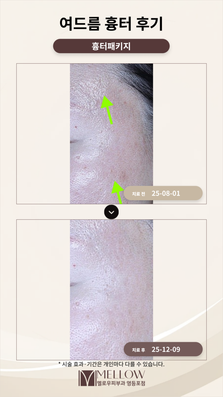 여드름 흉터 치료 방법 치료 후기로 살펴보기_영등포 피부과