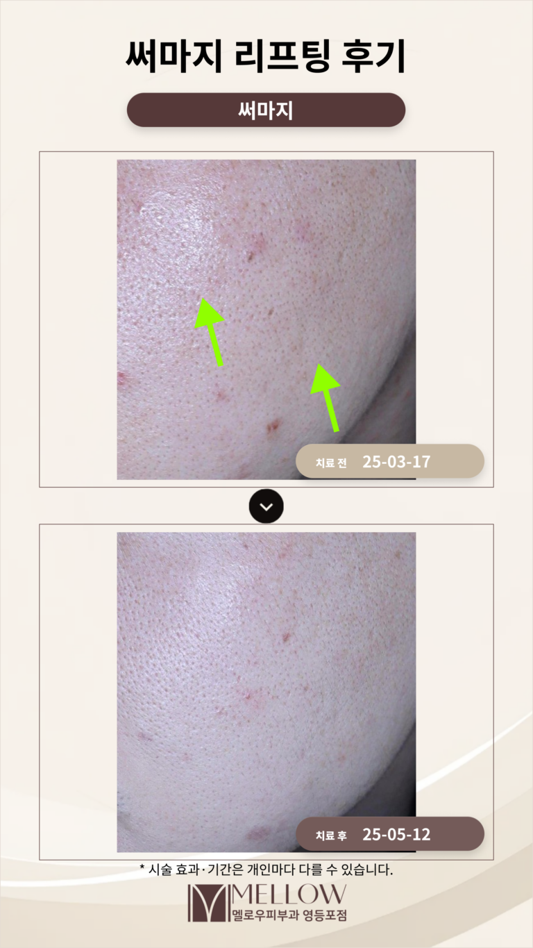 남자 처진 볼살, 써마지 효과 후기로 살펴보기_피부탄력 변화