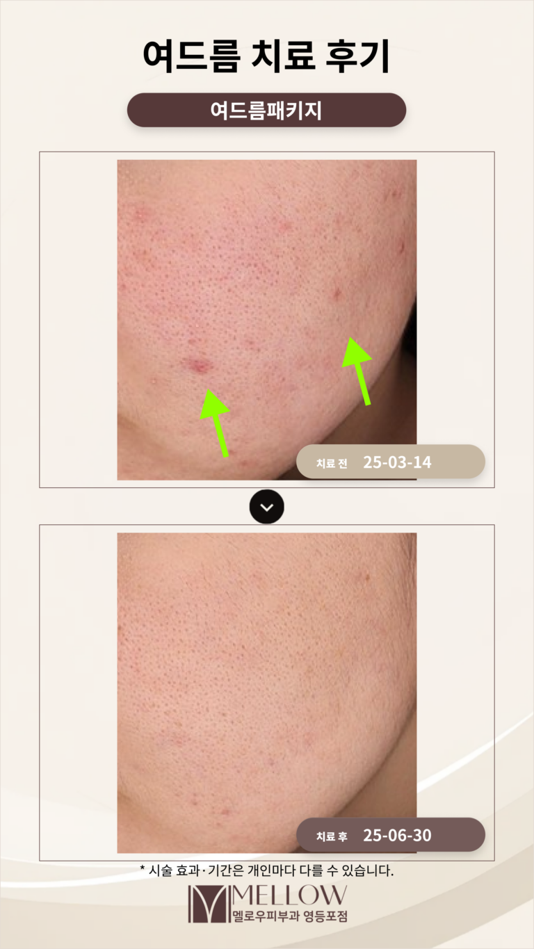 20대 여성 여드름, 여드름 흉터 치료 후기_영등포 피부과