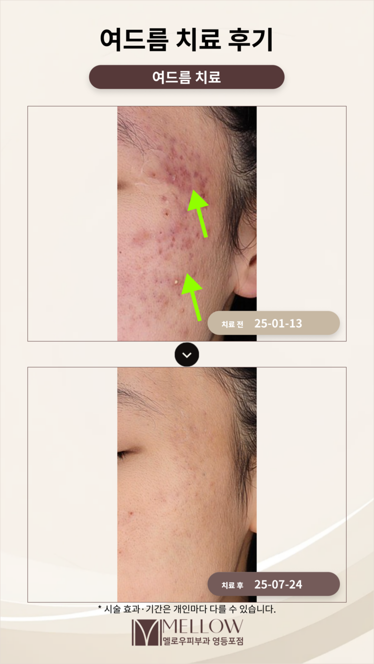 10대 여드름 치료 후기_효과적인 여드름 치료 방법