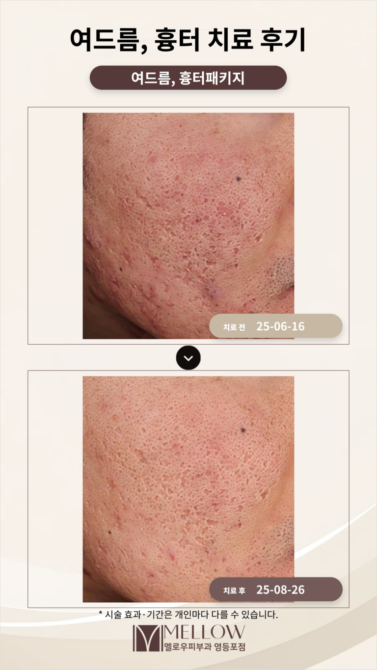 30대 여드름, 여드름 흉터 치료 후기_치료과정 소개