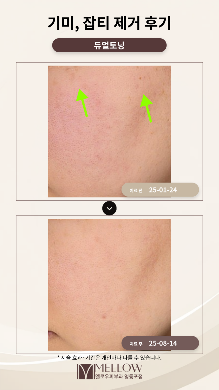 듀얼토닝 레이저 피부과 후기_영등포 피부과 전문의