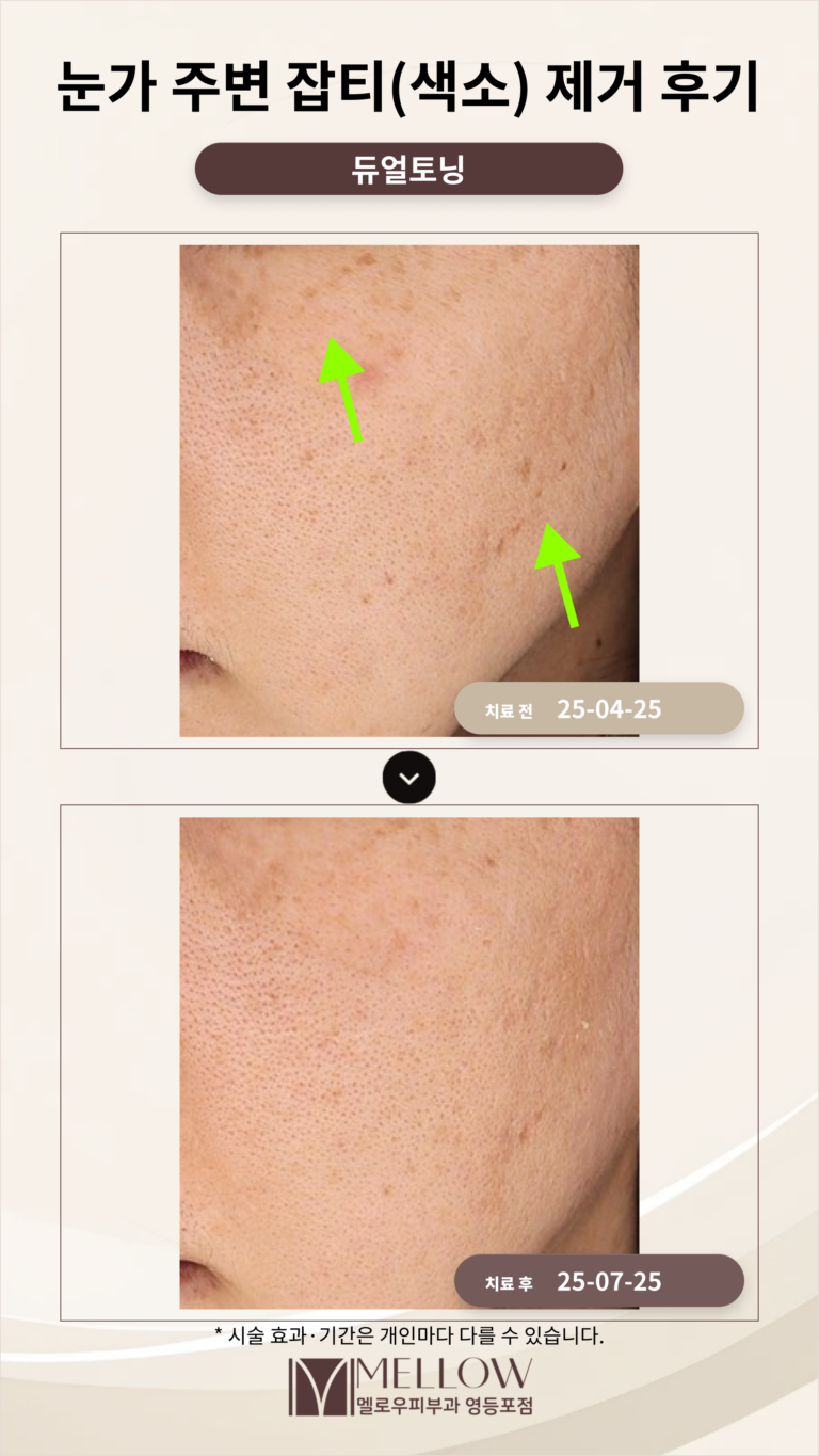 눈가 주변 잡티(색소) 제거 후기_잡티 제거 피부과