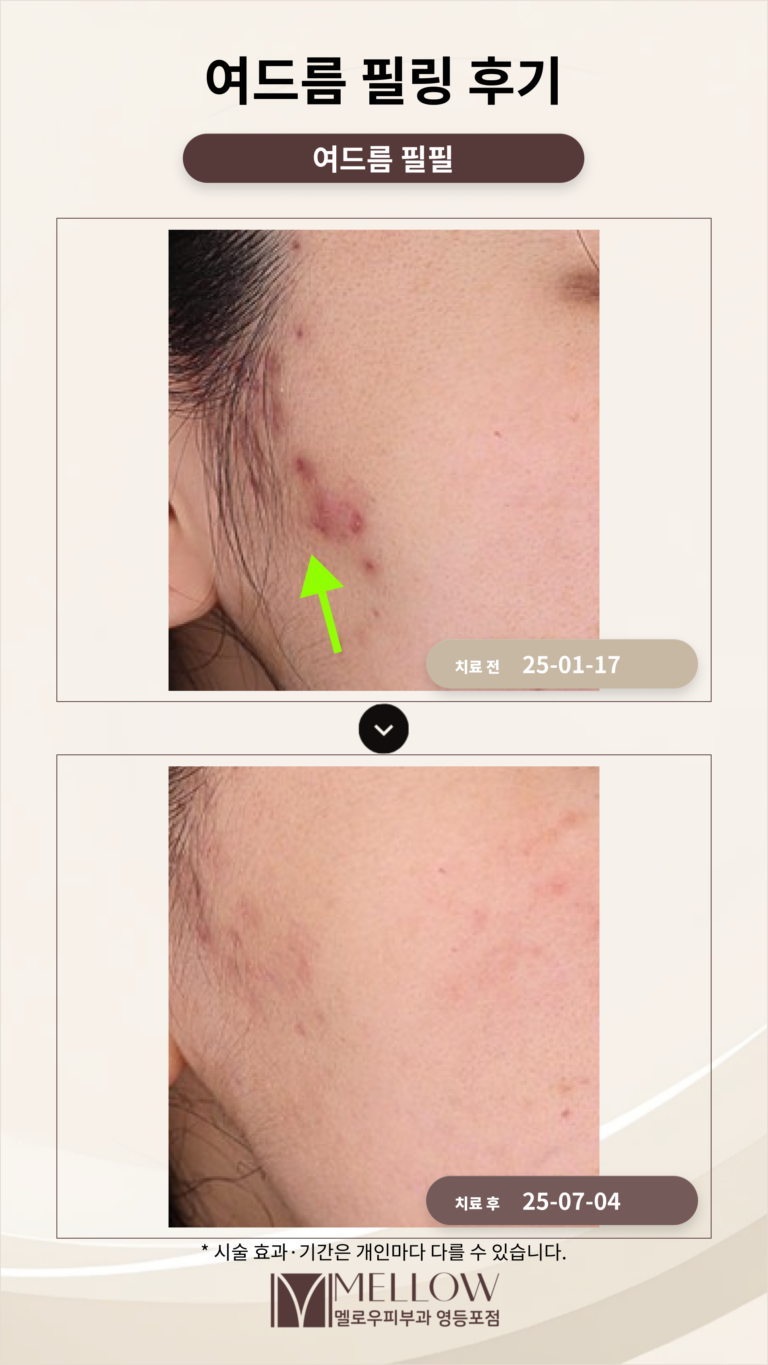 여드림 치료에 필링 효과 후기로 확인_여드름피부과