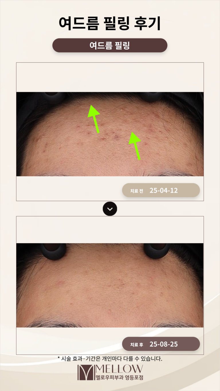 이마 여드름 필링 효과 후기로 살펴보기_여드름 피부과