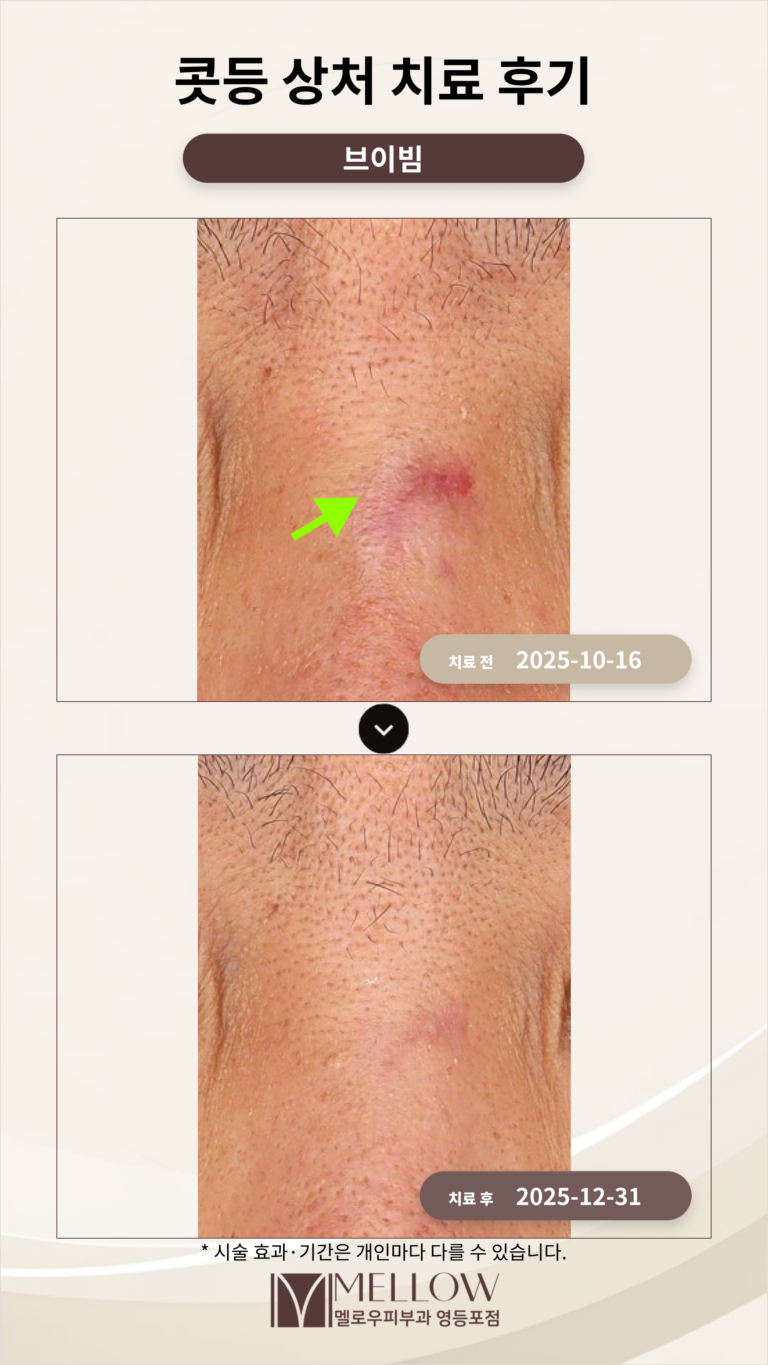 콧등 상처 치료 후기