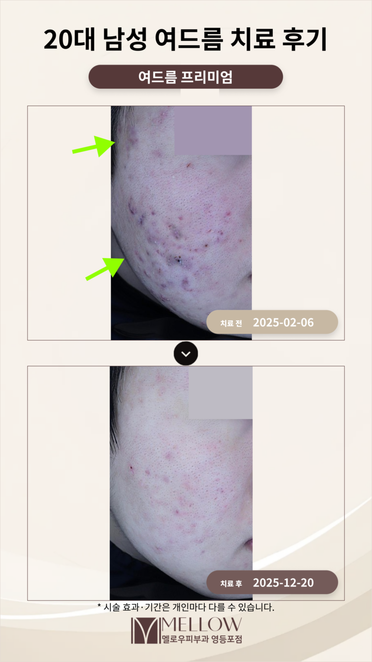 20대 남성 여드름 치료 후기
