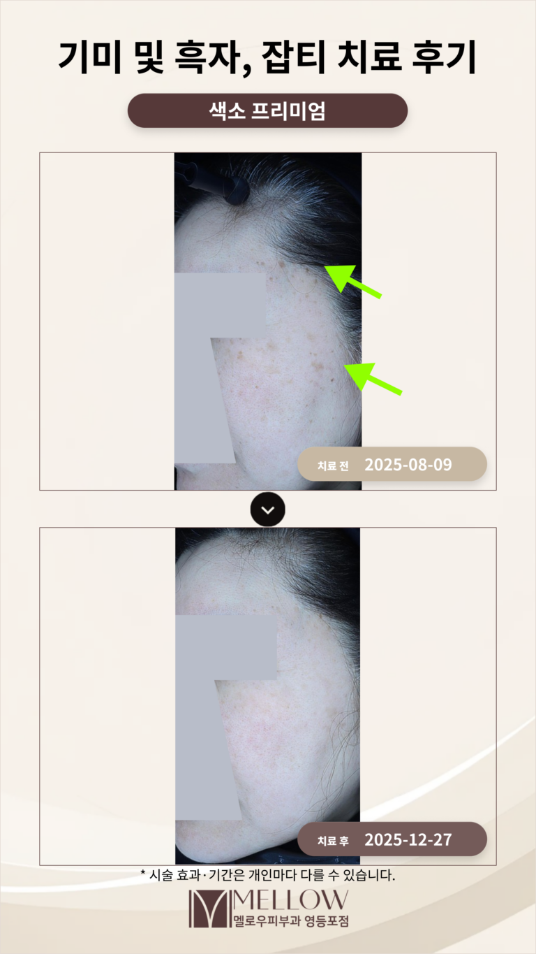 기미 및 잡티, 흑자 치료 후기