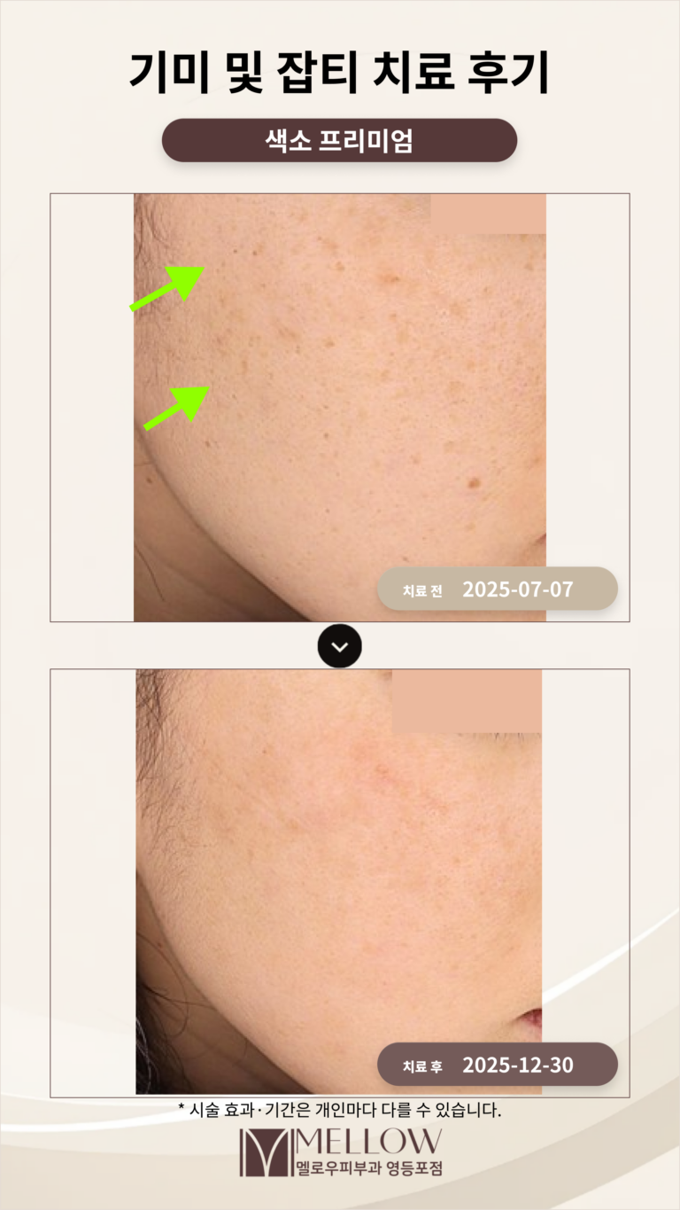 기미 및 잡티 치료 후기