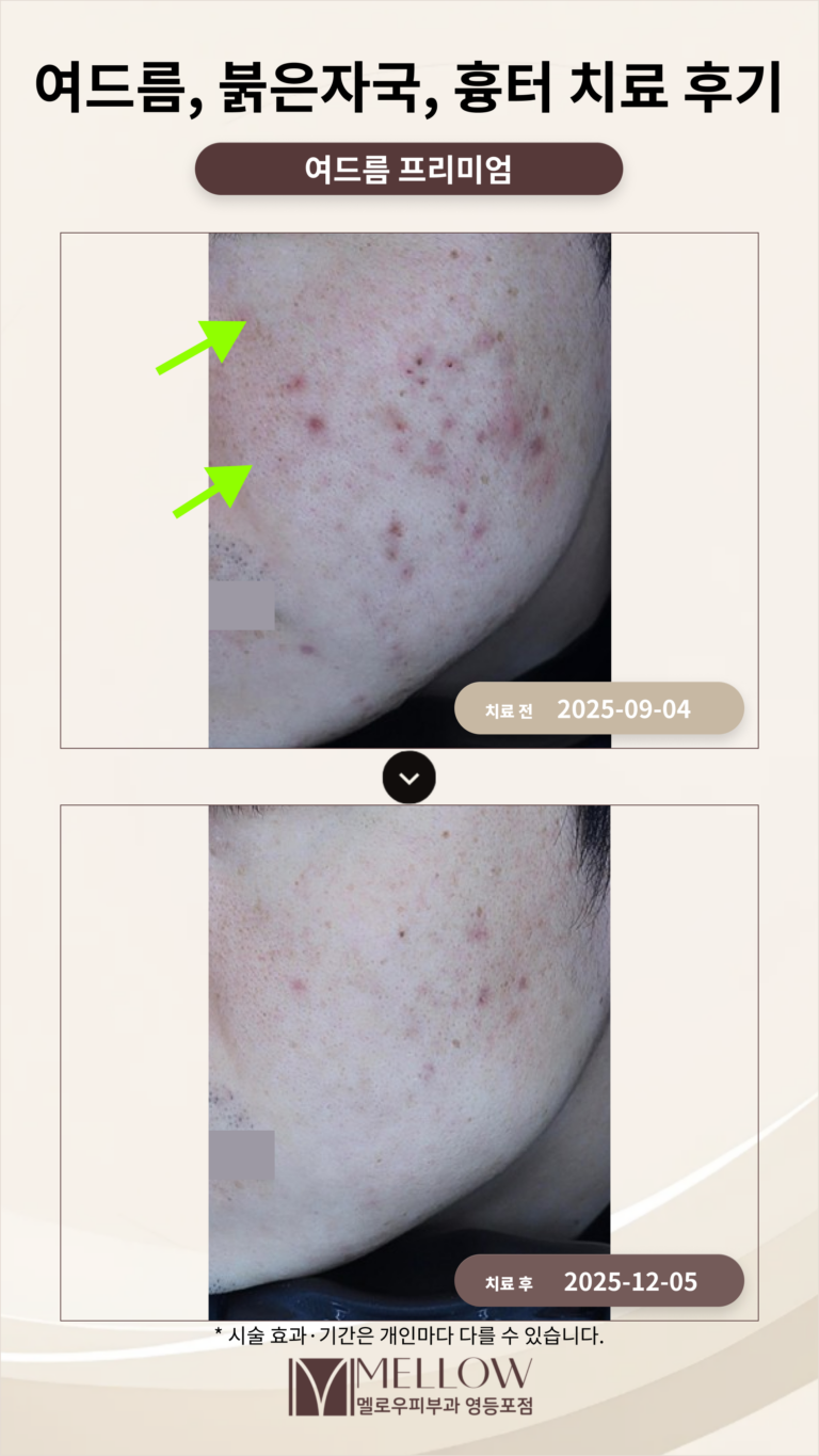 여드름, 붉은자국, 흉터 치료 후기