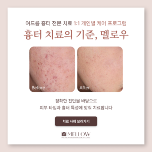 멜로우피부과 여드름 치료 후기 #영등포, 대림동, 보라매